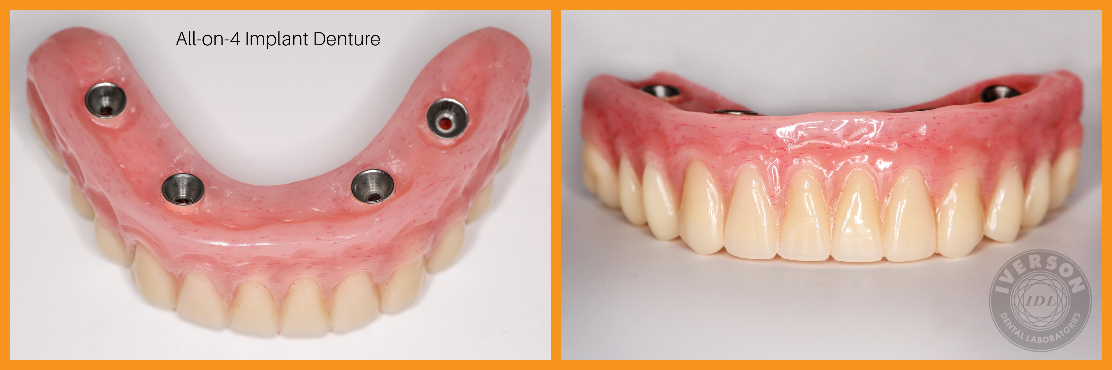 Metal-free trinia allows for lightweight implant dentures