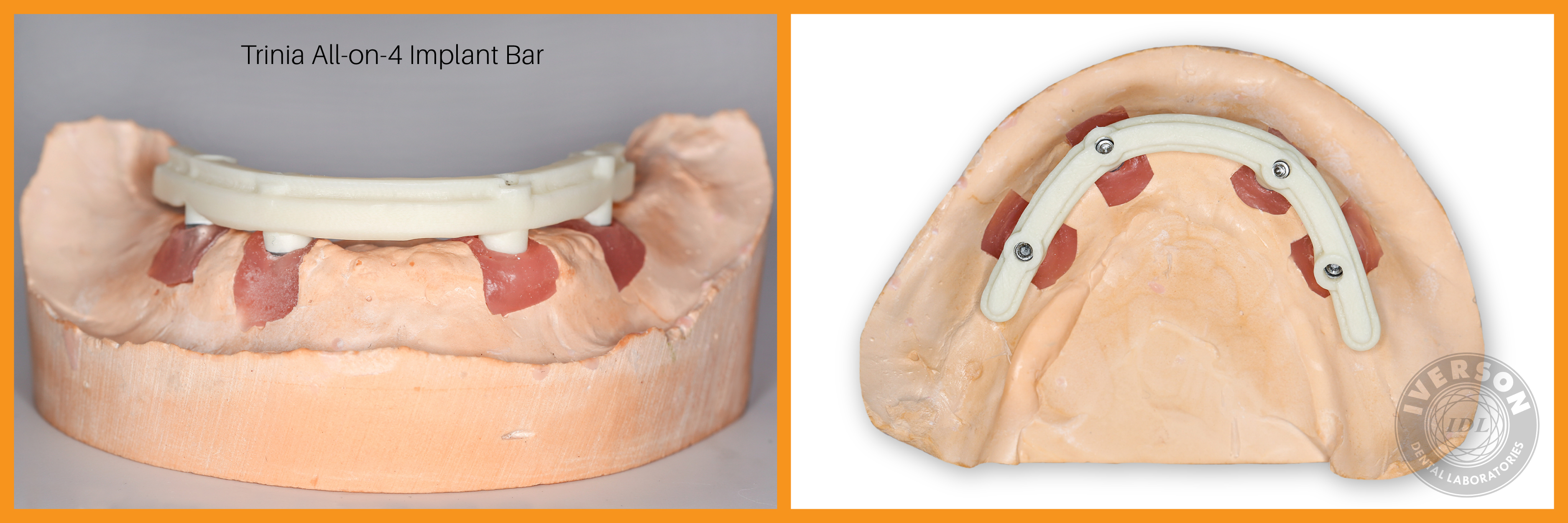 Trinia metal-free implant bar on dental model